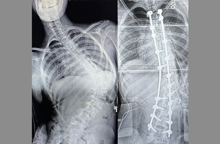X-ray images showing a before and after view of a spine surgery. The left image shows a curved spine, and the right image shows the spine straightened with metal rods and screws.