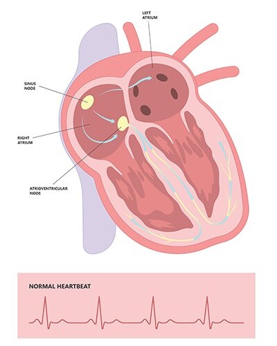 a diagram showing a normal heartbeat after cardiac ablation 