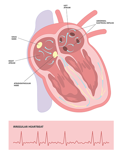 a diagram showing the irregular heartbeat before cardiac ablation 