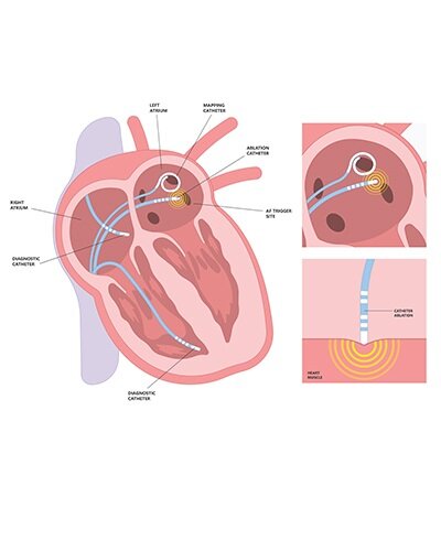 a diagram showing the heart during cardiac ablation 