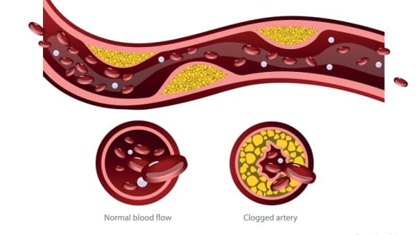 Visual representation of blood vessels, illustrating their significance in relation to heart attacks and blood circulation.