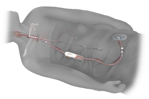 Illustration of TransCarotid Artery Revascularization (TCAR) treatment