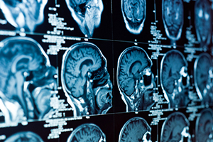 X-rays of a person's brain